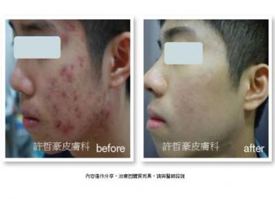 青春痘治療案例