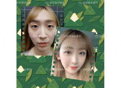 音波拉提與注射玻尿酸複合治療